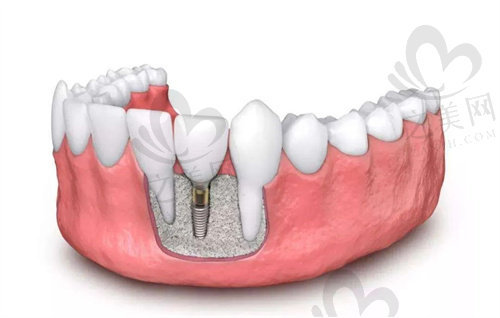 海口鼎点口腔种植牙价格