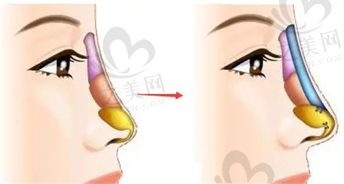 深圳宝丽医疗美容医院做鼻子怎么样