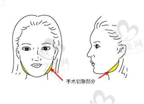 张笑天磨骨结果怎么样