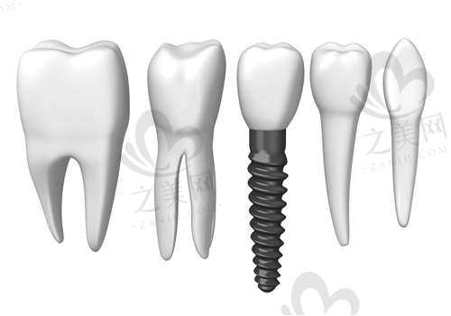 太原康达口腔门诊部推荐种植体及价格