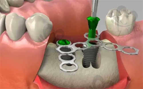 太原佳禾口腔医院洁利康种植牙怎么样