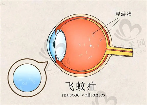 飞蚊症的困扰