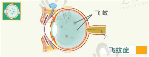 爱尔眼科飞蚊症消融术收费