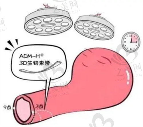 做完3D生物束带紧致度是多少