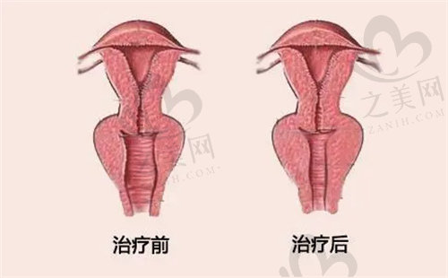 紧缩术缝合图前后对比
