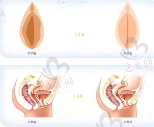 3d生物束带紧缩术多少钱