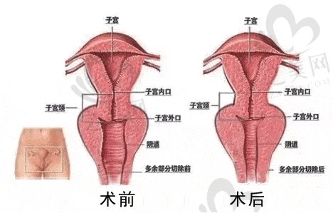 做了3d生物束带紧缩术后怎么护理