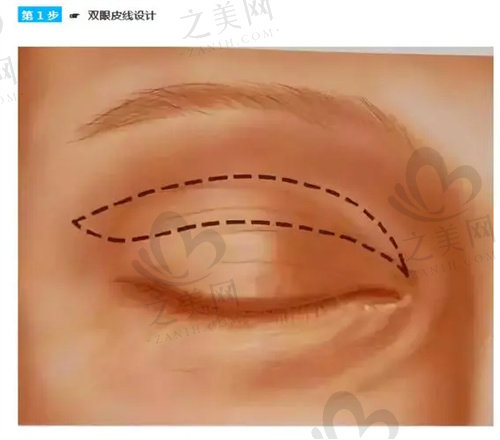 洛阳孔繁荣做双眼皮价格