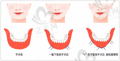 沈阳下颌骨截除修复多少钱