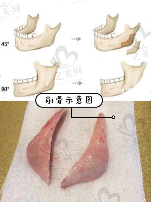 下颌骨截骨后别人不认识我了