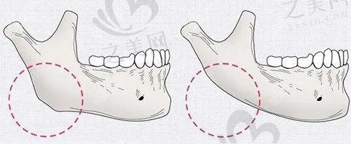 北京圣嘉荣医疗美容医院下颌骨截骨手术价格