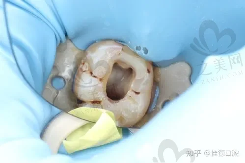 2023郑州吸附性义齿哪里做得好?友爱|美奥|唯美都不错