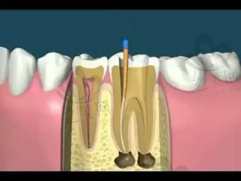 南宁氢氧化钙补牙口腔医院评分前十