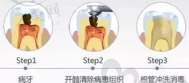 厦门拔智齿前10齿科(厦门思明斯迈尔口腔拔牙价格福利提前看)