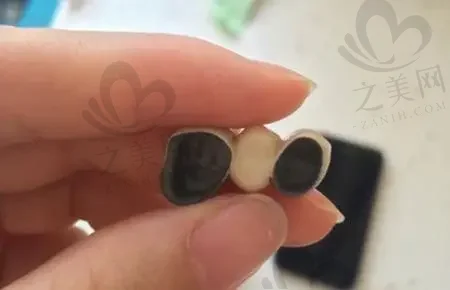 徐州钛锆合金种植牙医院排行前十分享:含徐州第三人民医院口腔科