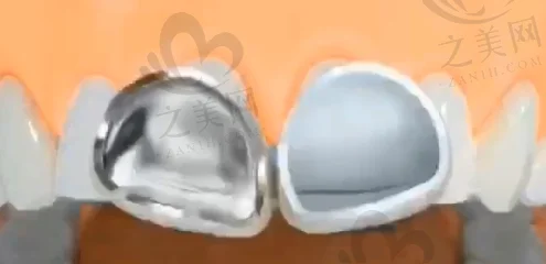 温州儿童龅牙矫正排名前十医院公布,看温州儿童牙齿矫正哪里好