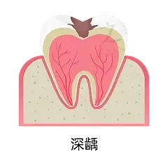 东莞牙状 元口腔做根管治疗怎么样