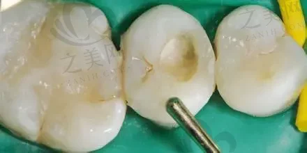 2023杭州牙齿黑三角治疗齿科医院前十口碑排名(杭州国雅口腔医院很不错哦~)