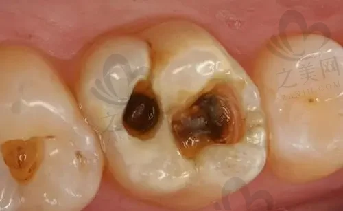 东莞烤瓷牙排行前十正规牙科医院(东莞大岭山牙博士口腔人气高)