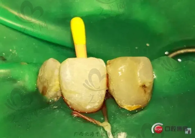 广州仿生牙固定口腔医院排名榜前十,广州优典口腔口碑爆棚!