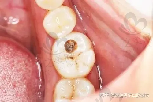 2023温州多颗种植推荐前十齿科医院(温州拜尔口腔医院优先登顶)