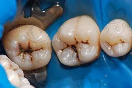 2023福州半固定牙齿口腔美容医院前十口碑榜(福州医科大学附属协和医院口腔科在当地人气没的说)