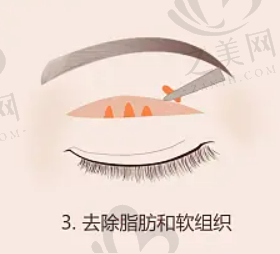 手上的老年斑怎么治?激光祛斑有没有用?怕疼的话药物涂抹可以吗?