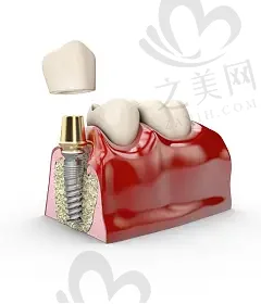 泉州韩国百康种植牙排名前十的口腔医院,西华|维乐等医院实力上榜
