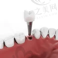 2023广州活动义齿修复正规口腔医院排名,均是官方认证口碑牙科
