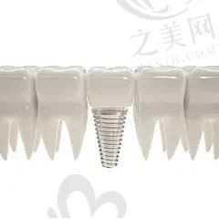 2023天津全口牙种植牙口腔医院强榜,看全口种植牙哪家医院较好?