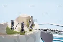 2023深圳阻生牙拔牙权威口腔医院评价前十(深圳同步口腔更有名气)