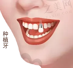 2023嘉兴早期种植修复排名榜top10强医院(嘉兴海宁圣麦口腔门诊部好评双双爆表)