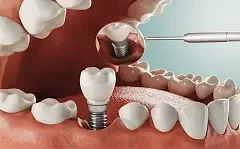 南宁氢氧化钙补牙口腔医院评分前十