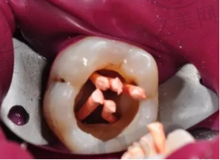 根管治疗加牙冠多少钱一颗？主要看龋齿问题是否严重
