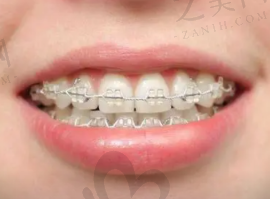 19岁矫正牙齿需要多久？一般来说一两年足矣