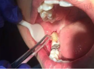 拔牙整牙的后遗症 矫正拔牙会有后遗症吗
