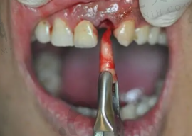 拔牙整牙的后遗症 矫正拔牙会有后遗症吗