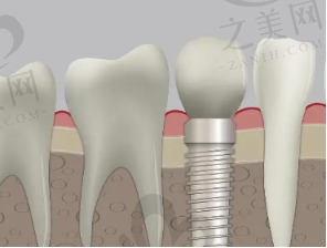 种植牙可以洗牙吗 有种植牙能不能洗牙